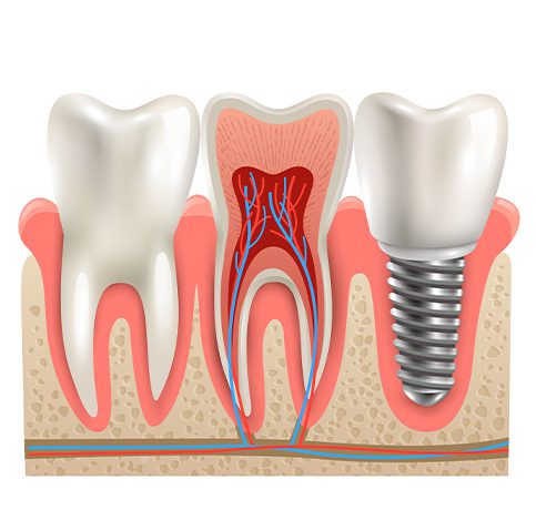 Dental Implants