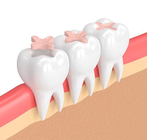 Restorations/Fillings