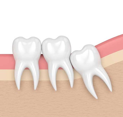 Impacted/3rd molar Extraction