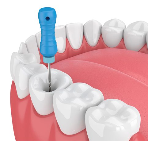 Endodontic Surgery