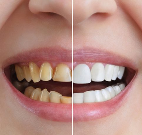 Full Mouth Rehabilitation