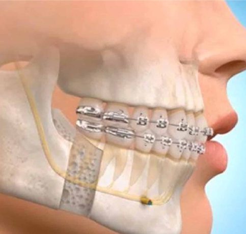 Maxillofacial surgery