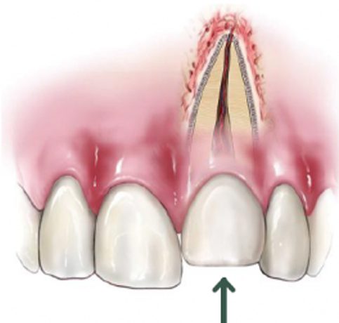Dental Fracture