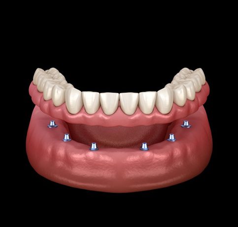 Dentures