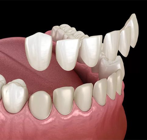 Veneering