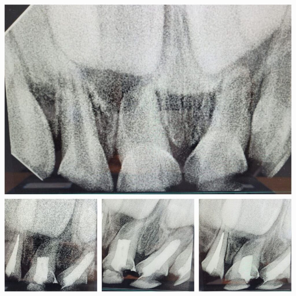 Teeth Alignment