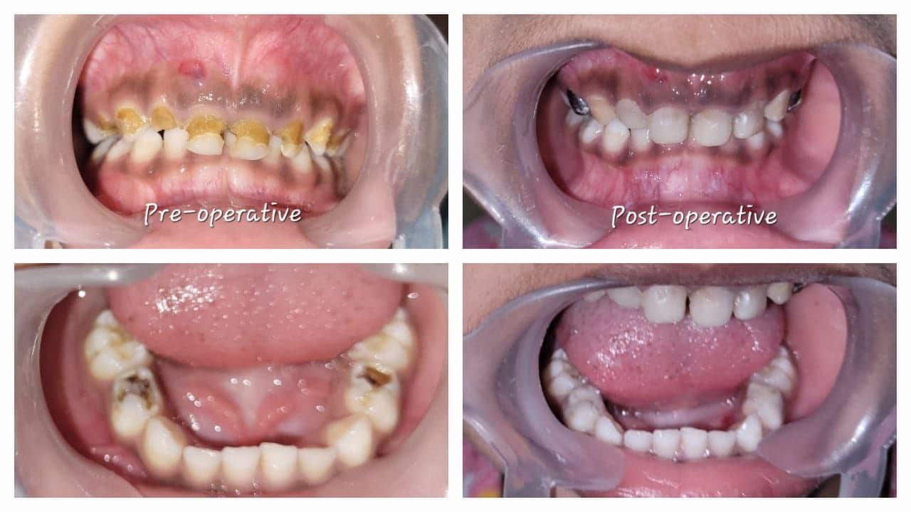 Teeth cleaning