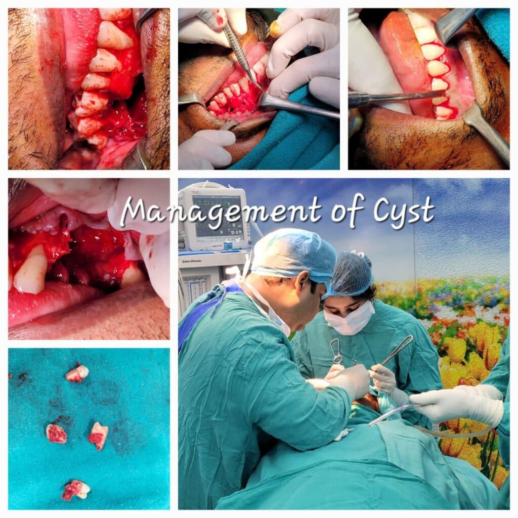 Management of Cyst