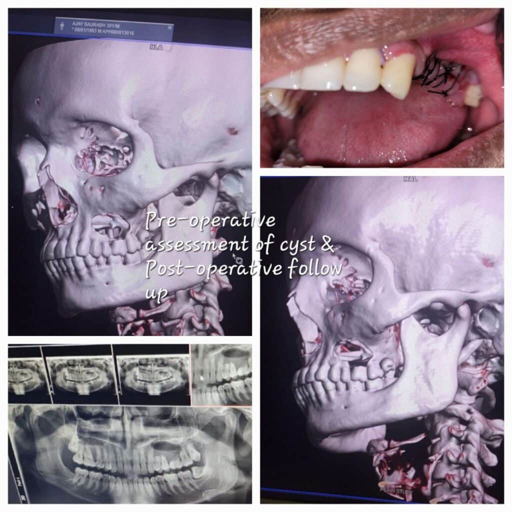 Pre-operative assessment of cyst & Post-operative follow up