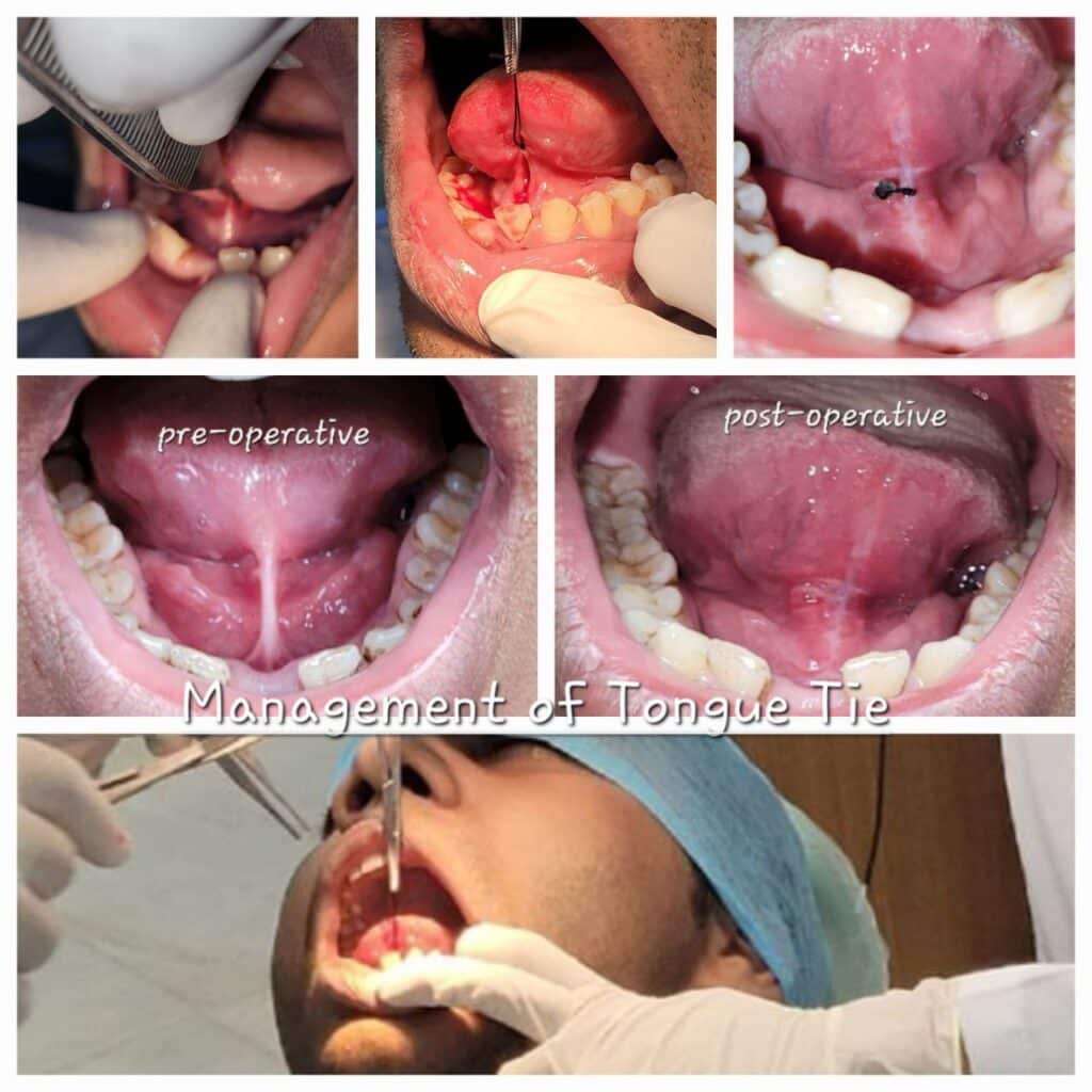 Management of Tongue Tie