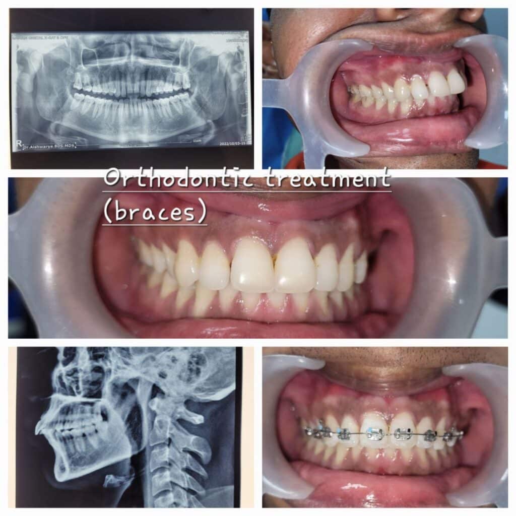 Orthodontic treatment (braces)