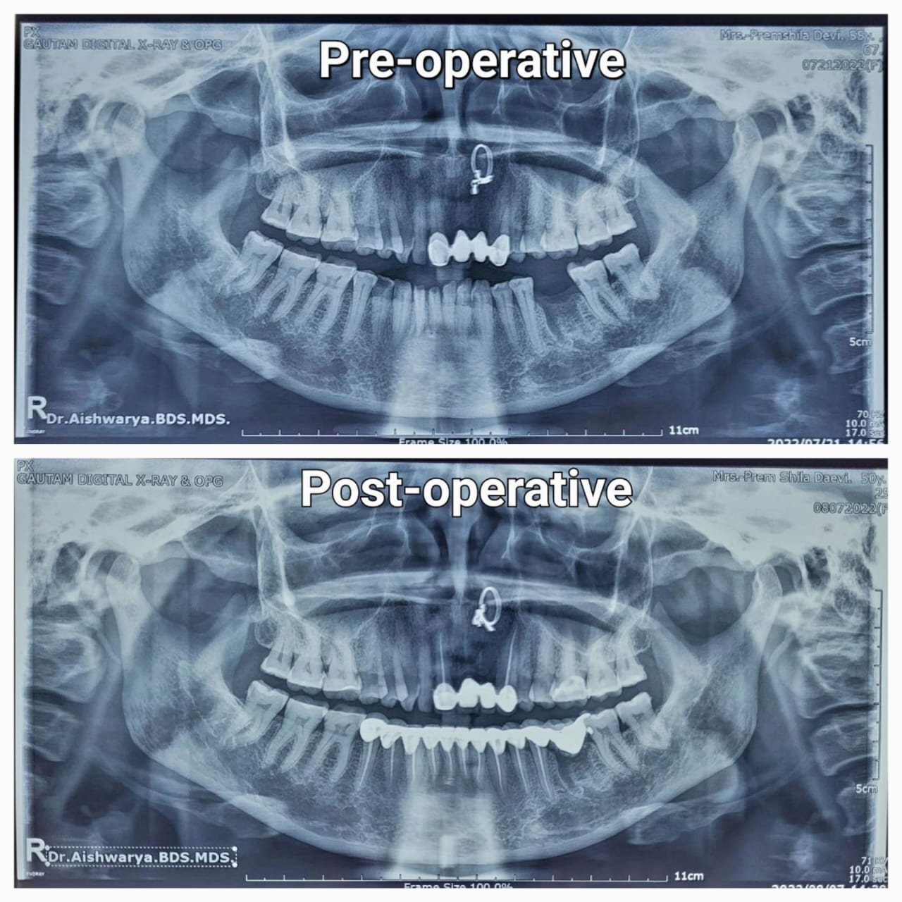 Root canal Treatment Specialist