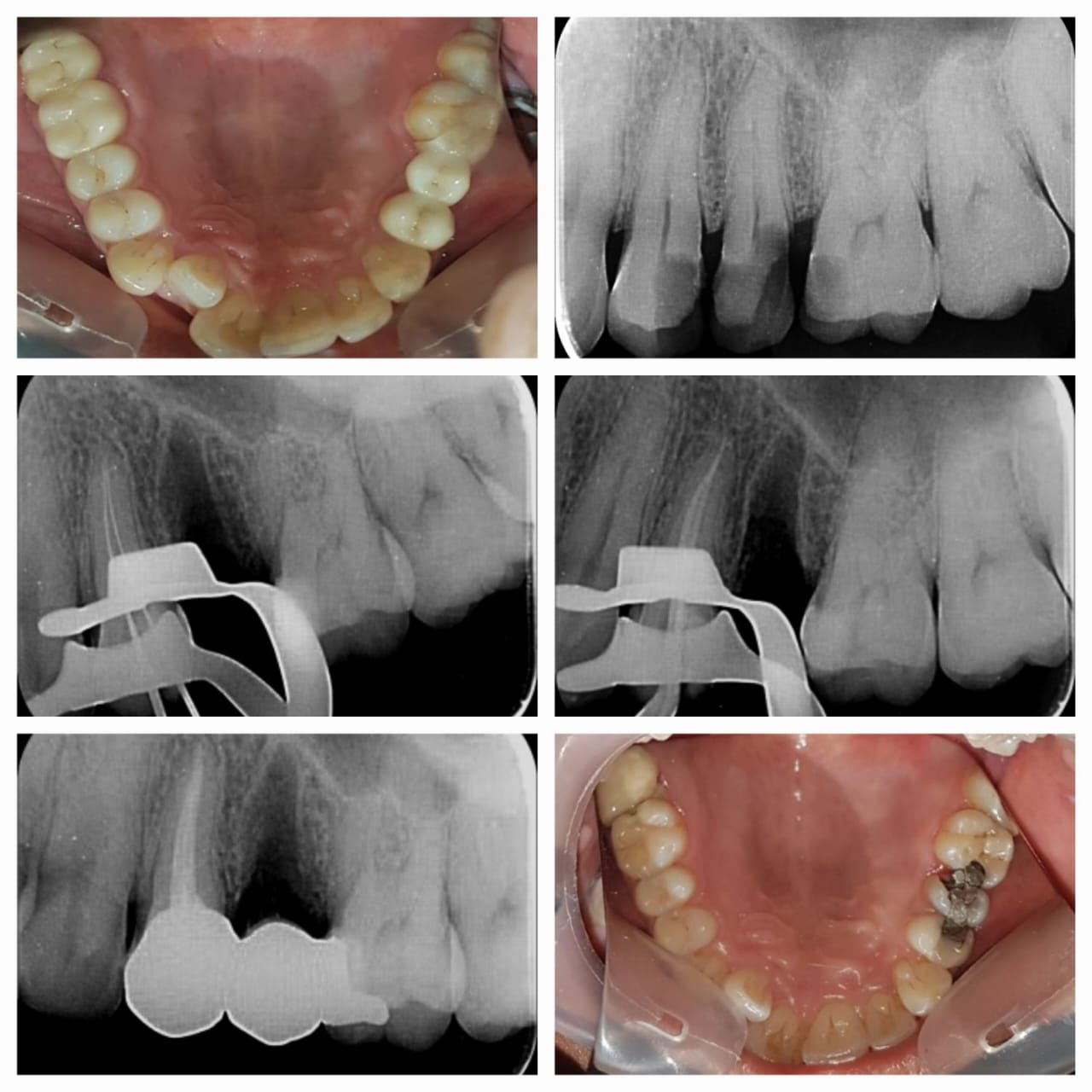 Sample of Root Canal Issue
