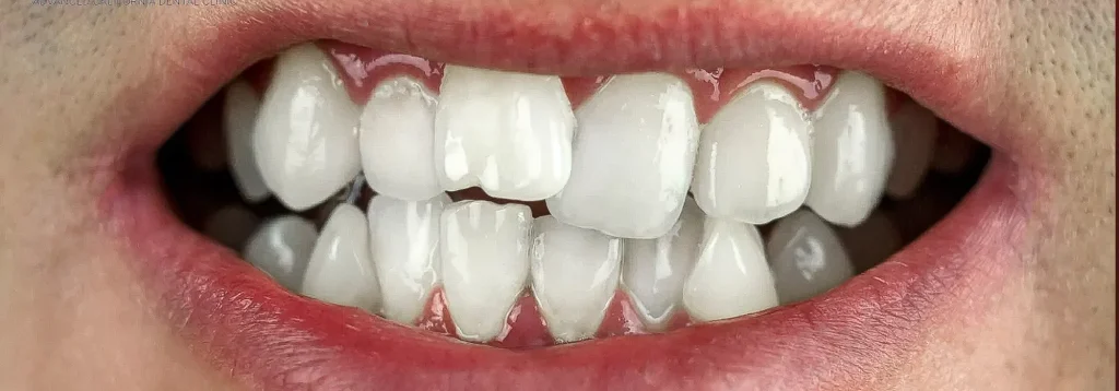 Teeth Overcrowding