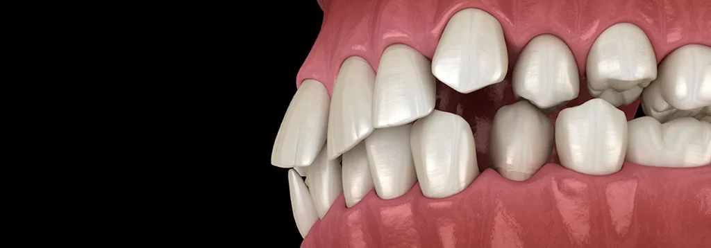 Tooth Overcrowding