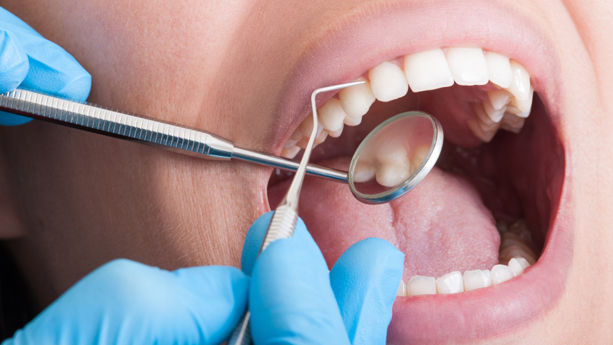does teeth cleaning include cavity removal
