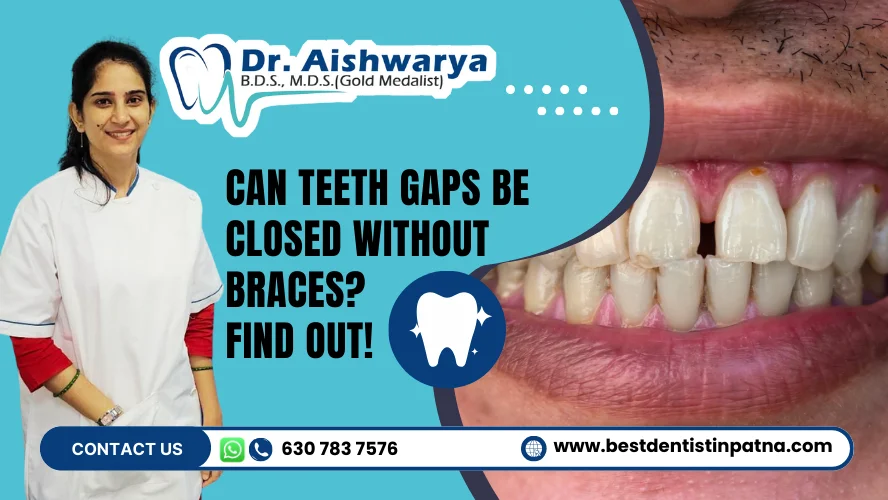 can teeth gaps be closed without braces