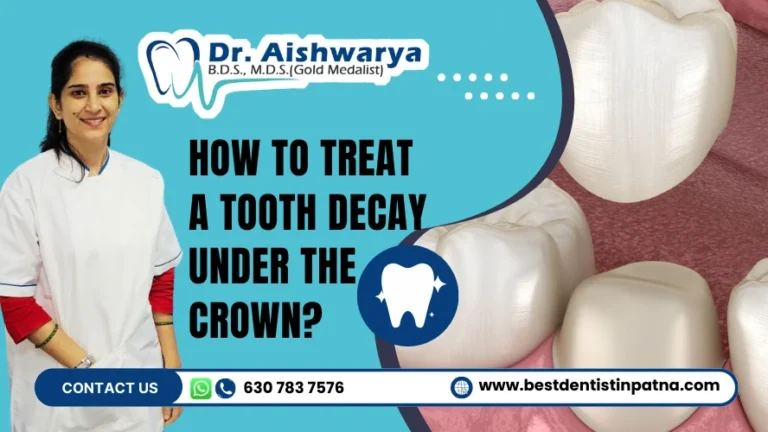 Tooth Decay Under a Crown