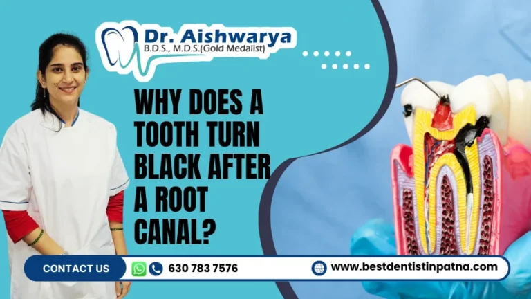 Tooth Turning Black After a Root Canal