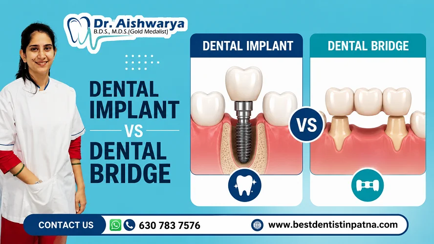 Dental Implant vs Dental Bridge