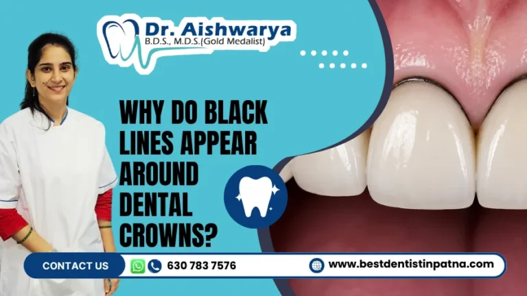 Black Lines Appear Around Dental Crowns