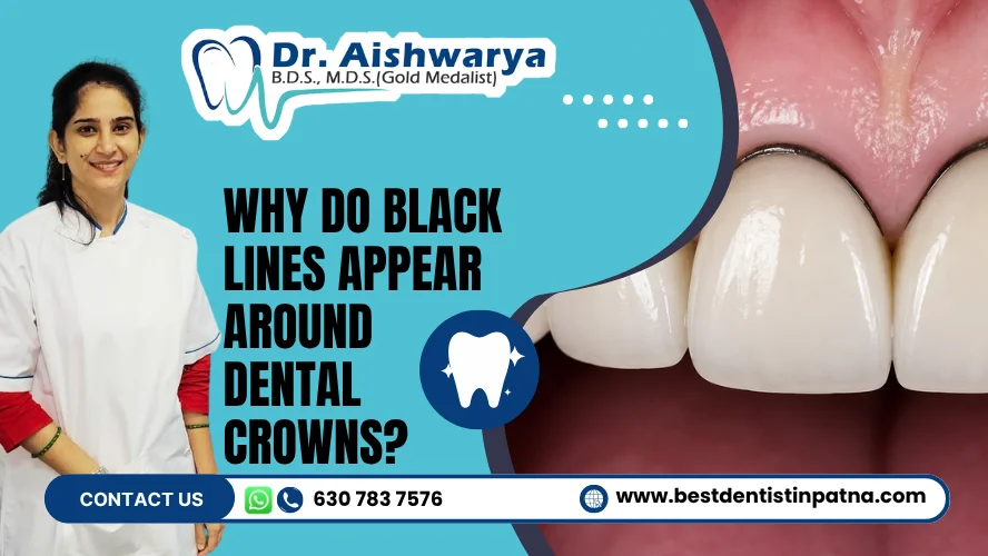 Black Lines Appear Around Dental Crowns