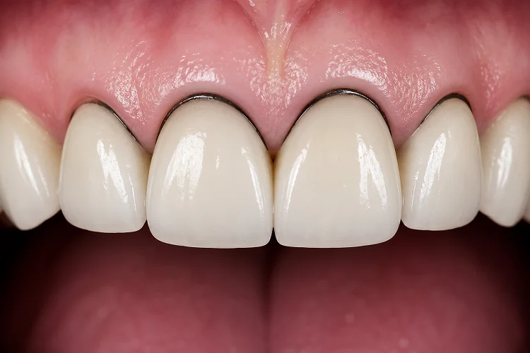 Black Lines Around Dental Crowns