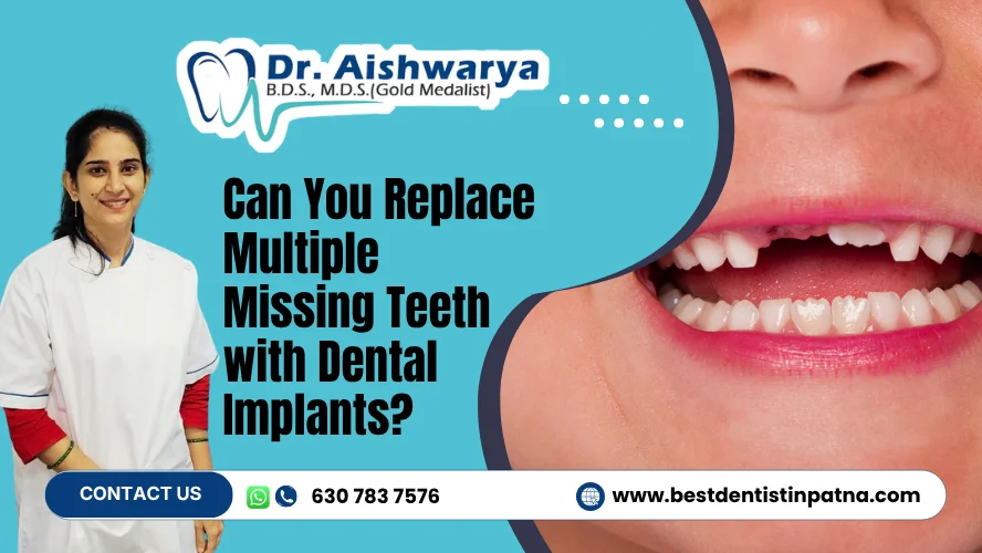 Dental Implants for Multiple Missing Teeth